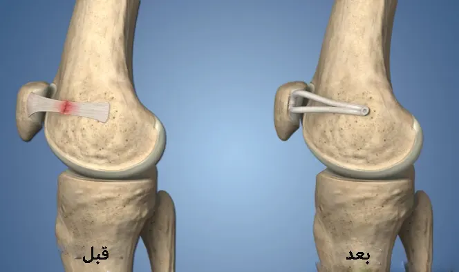 جراحی استئوتومی زانو