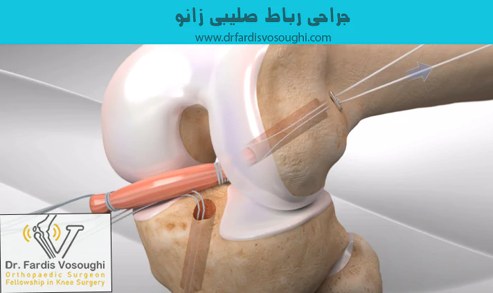 جراحی رباط صلیبی زانو