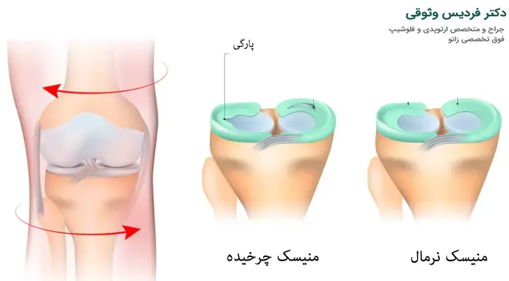 تشخیص پارگی منیسک زانو