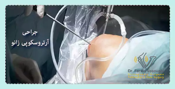 جراحی آرتروسکوپی زانو