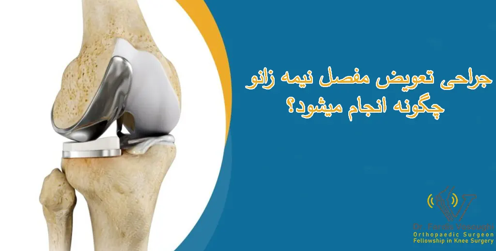 تعویض مفصل نیمه زانو