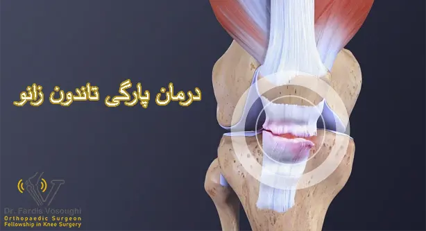 درمان پارگی تاندون زانو