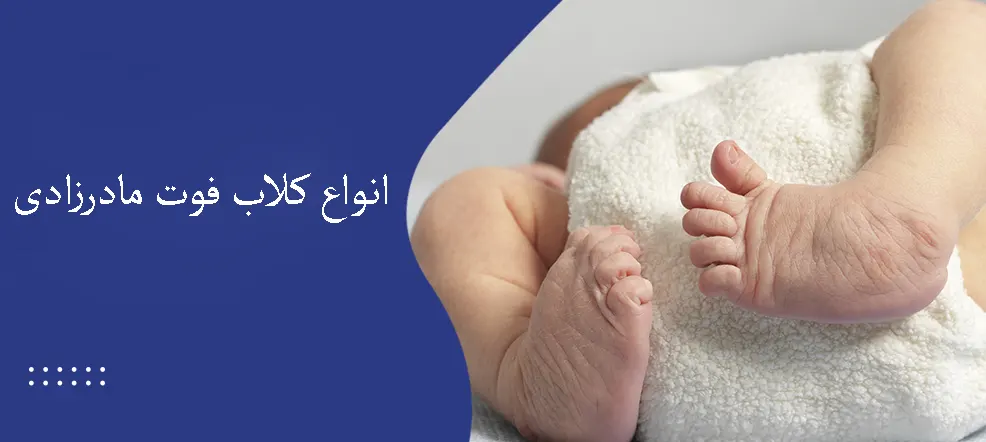 انواع کلاب فوت مادرزادی