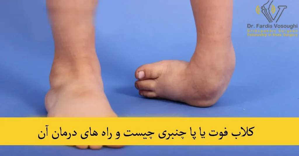 کلاب فوت یا پا چنبری
