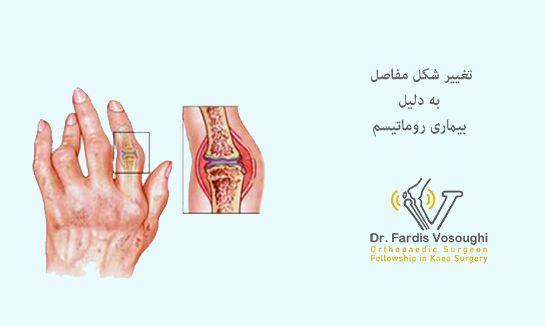 تغییر مفاصل به دلیل روماتیسم