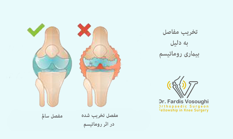 روماتسم بیماری خود ایمنی