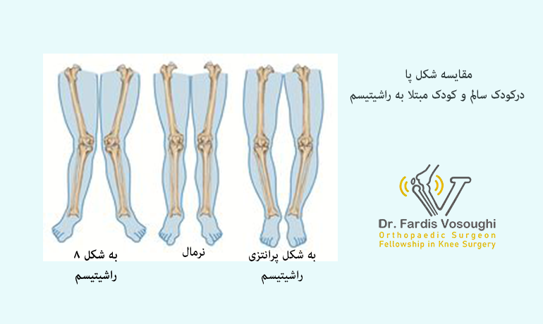 مقایسه پای سالم و راشیتیسم