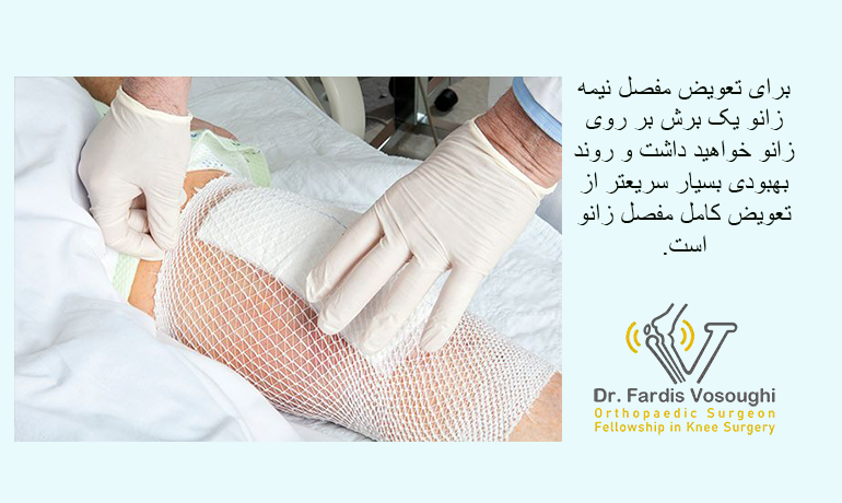 مزایای تعویض نیمه مفصل زانو