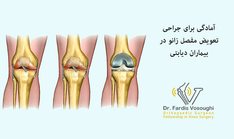 آمادگی برای جراحی تعویض مفصل زانو در بیماران دیابتی