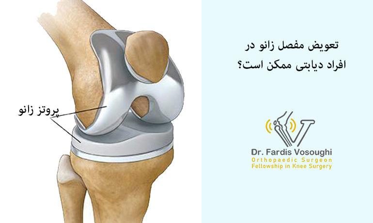 تعویض مفصل زانو در افراد دیابتی ممکن است