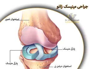 جراحی مینسک زانو