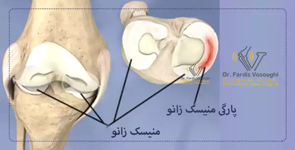 عکس پارگی مینسک
