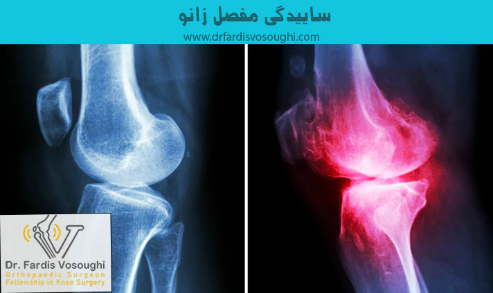 ساییدگی مفصل زانو