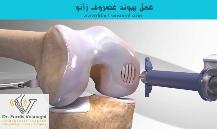 عمل پیوند غضروف زانو